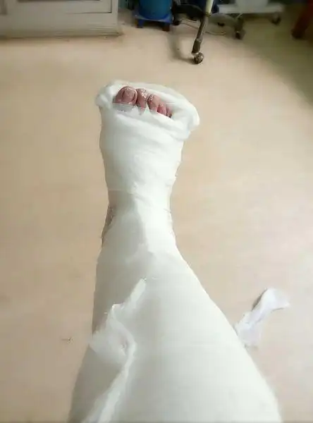 石膏固定后,应注意哪些?