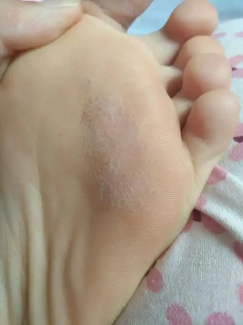 我的脚是不是有什么真菌感染了?