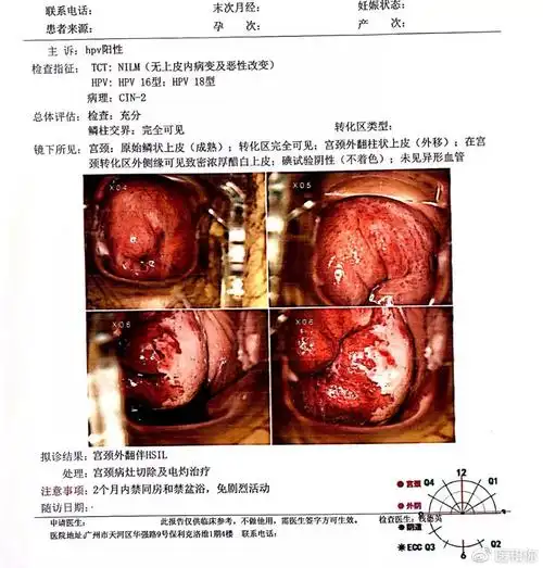 医案宫颈外翻leep锥切影响备孕钱德英主任花瓣型切除法进行手术