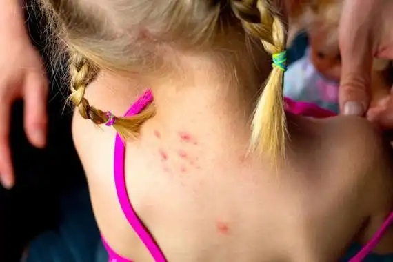 被果蝇咬了伤口图片