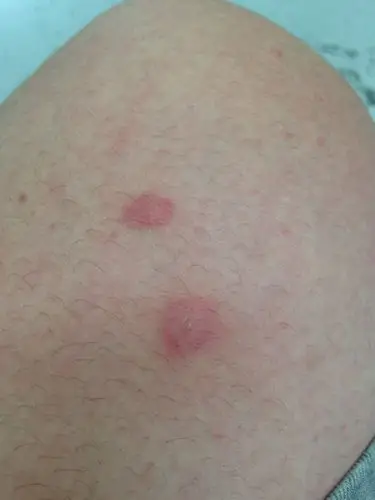 谁知道这是被什么虫子咬的_百度知道