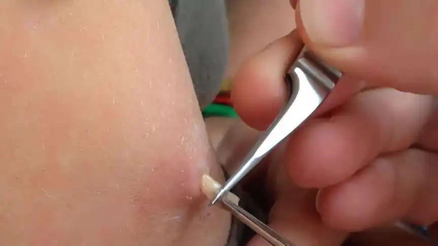 小美手臂被马蝇幼虫寄生了,兽医用镊子夹出来,过程太解压了-动物视频