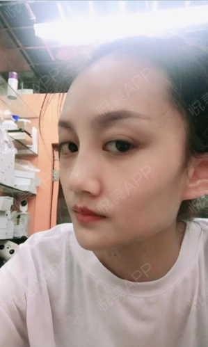 线雕隆鼻术后第7天