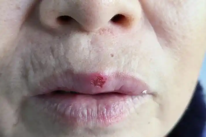 女性单纯疱疹图