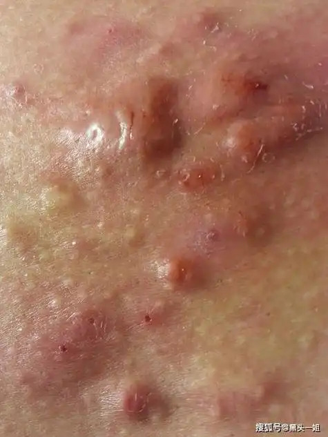 闭口是什么图片闭口粉刺 即专业上称之为的闭合性粉刺.