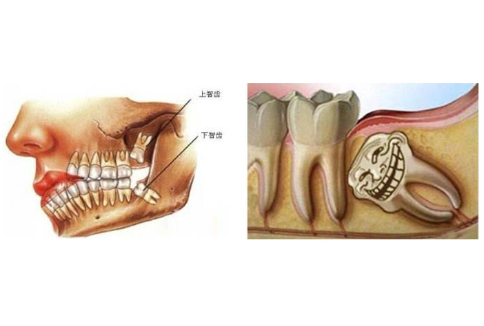 你的牙齿是28颗还是32颗?世界上还有人长了200多颗牙齿!