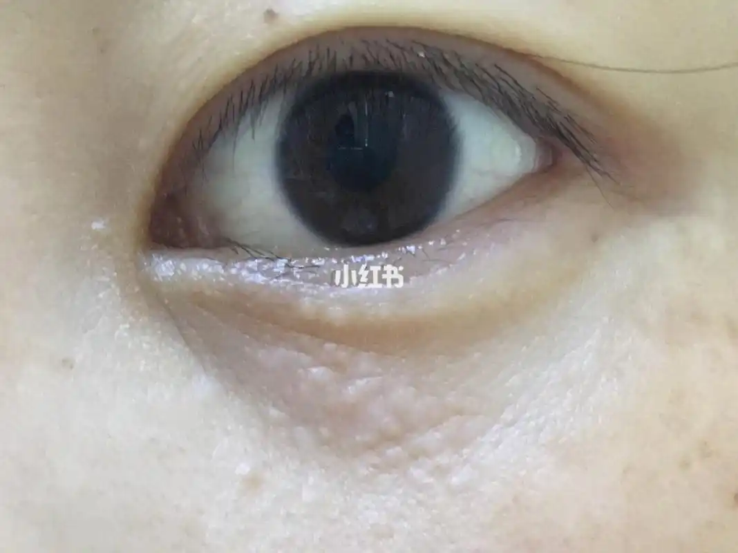 汗管瘤#汗管瘤 这个烦人的东西,伴随了我快十五年了!