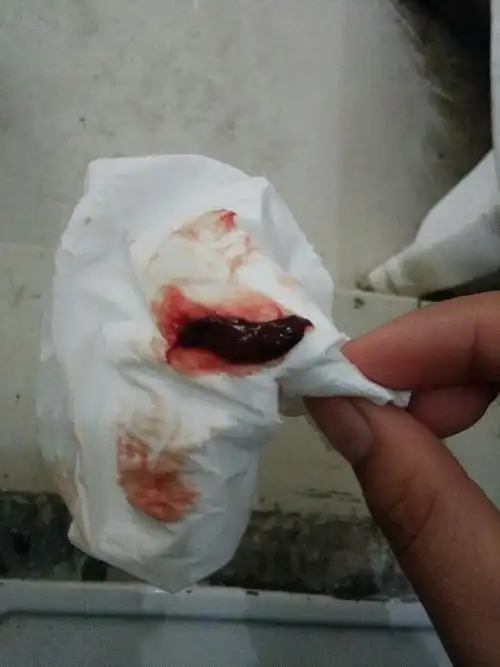 09.08打胎过一次,那时候血快很小