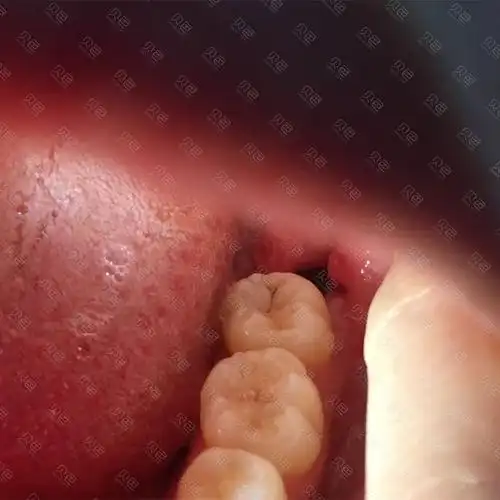 拔完智齿以后有牙洞,你们有吗?