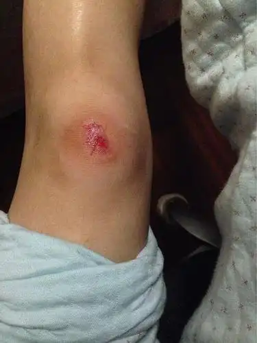 跑着跑着就摔了…膝盖流血了!