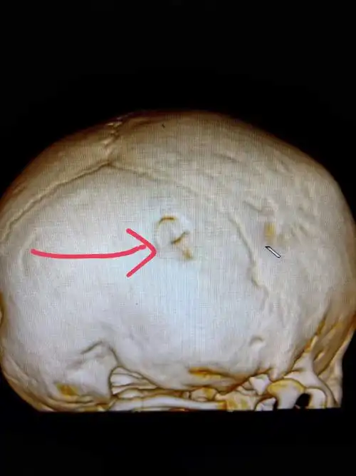 孩子不小心磕着头怎么办