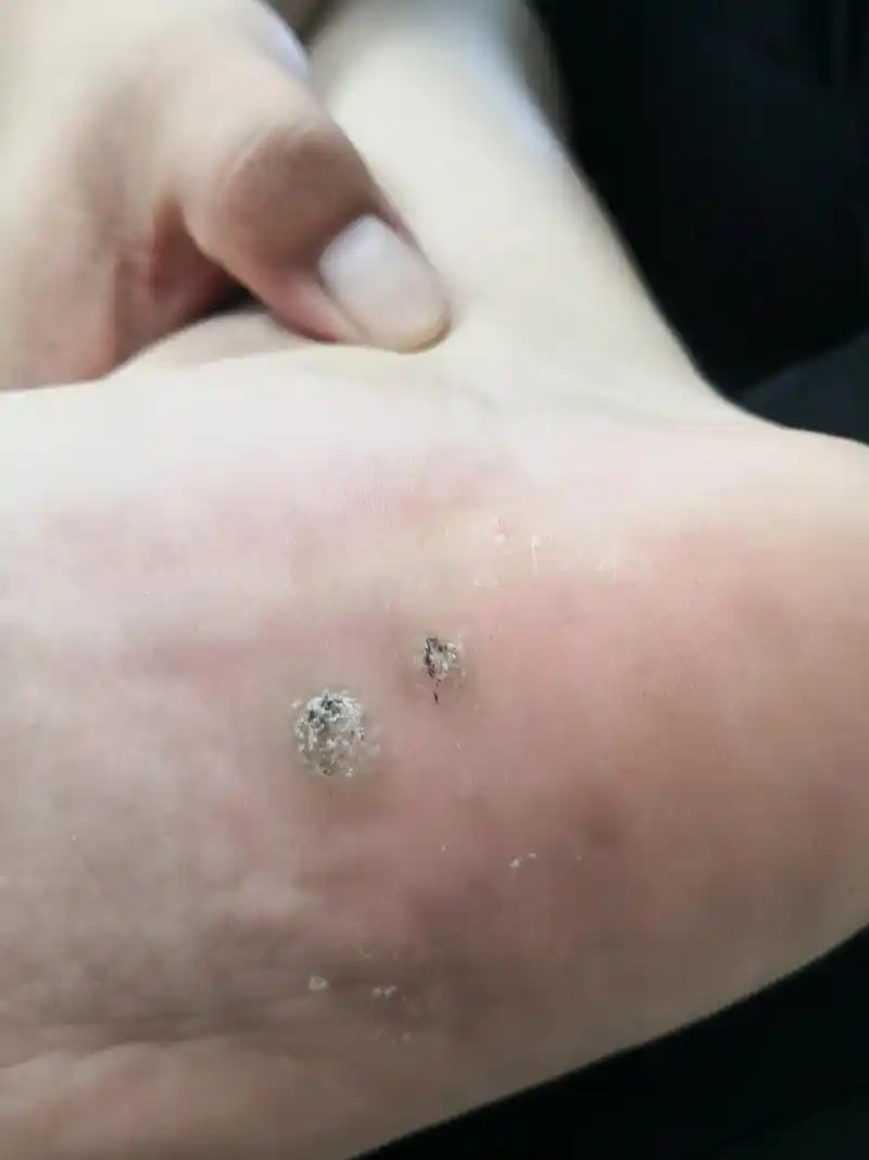 足底跖疣症状#跖疣##病毒