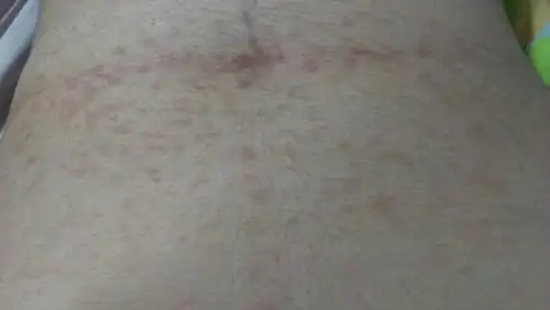 我肚子上出现了许多这种一点一点的斑是什么东西?是病吗?