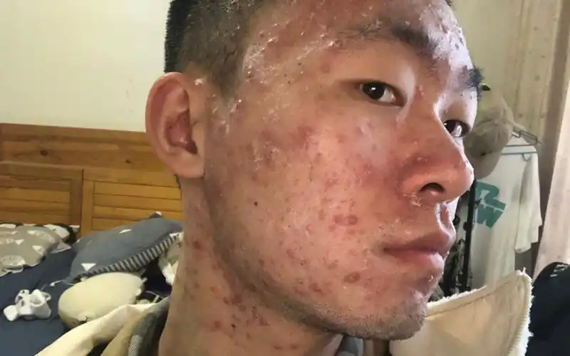 胆小误入,考研前30天,满脸全身长水痘!_哔哩哔哩_bilibili