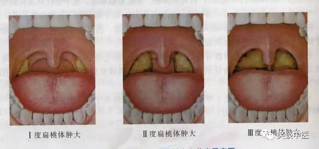 扁桃体发炎最怕一碗水『扁桃体肿大最好的治疗方法』