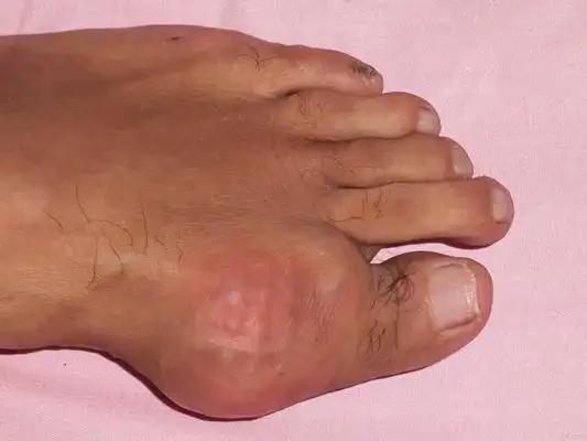 痛风早期症状图片 (57)