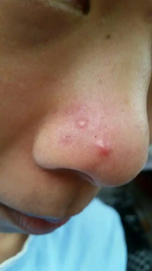 我鼻子两侧经常长这种痘痘,过一段时间能挤出一粒白色