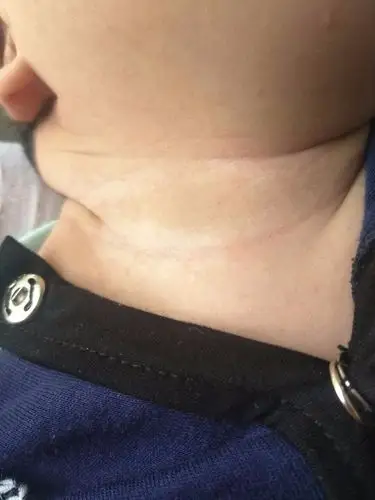 孩子三个多月大,脖子处发白半个月多了,帮忙看看是白癜风吗