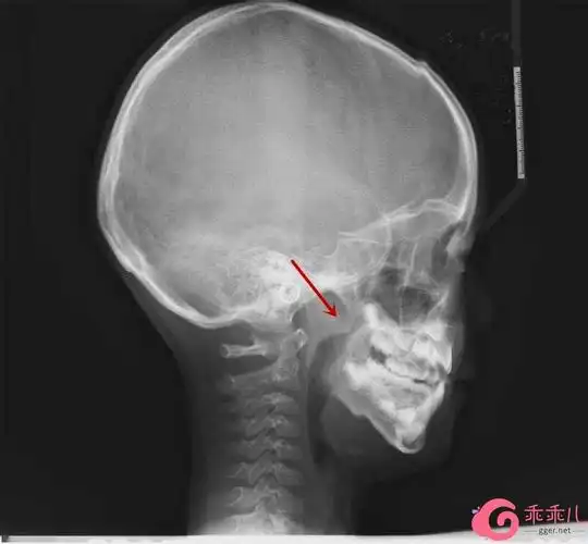 有些家长担心鼻咽侧位x光片辐射量较大,会对孩子身体造成损害.