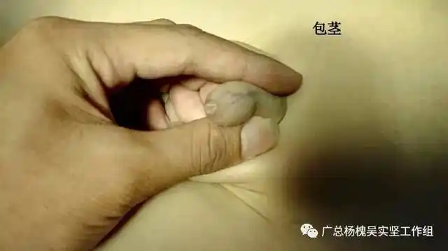 包茎是指因为包皮口狭小或包皮与龟头粘连,包皮不能上翻露出龟头. 1.