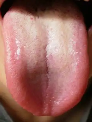 此图为虚火的舌苔,舌头整体发红,跟舌头一 样平的红点舌称为