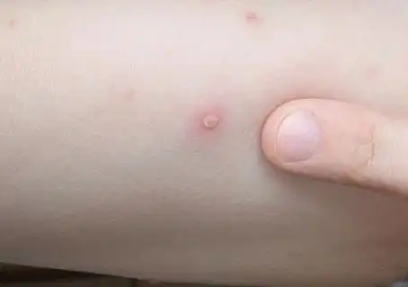 水痘的7天演变过程图片水痘第一天图片