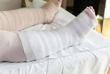 病人的腿缠着绷带照片