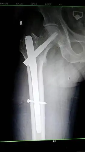 高龄患者髋部骨折---pfna内固定术