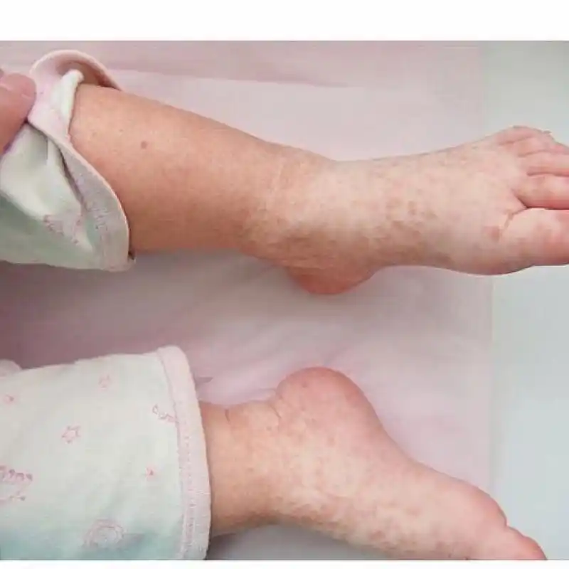 儿童身上出现大片色素脱失斑这种不是白癜风 如图,遗传性对称性色素