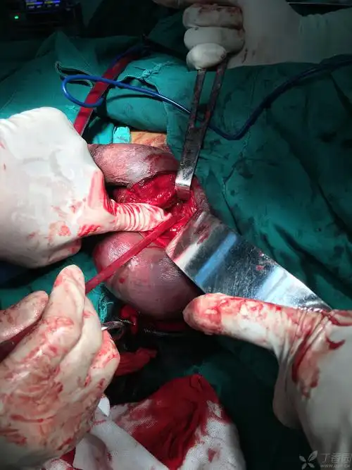 一例少见的阴茎海绵体断裂