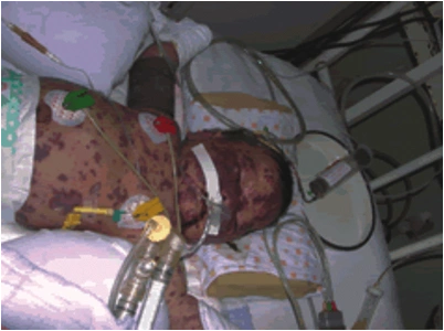 通过cdap活化多糖制备b型流感嗜血杆菌荚膜多糖-d蛋白疫苗初探