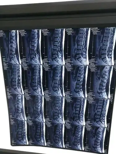 宣武半椎板腰椎l2/3占位切除术