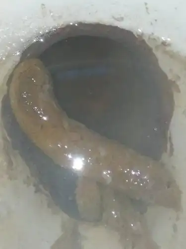 这大便白色的东西是什么?要不要做什么检查?