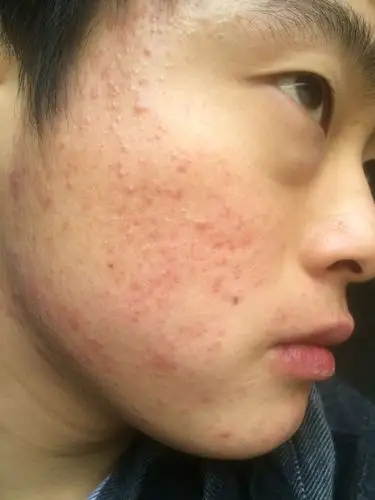 原先脸上有青春痘,好了以后面部泛红,而且皮肤上面有小点!