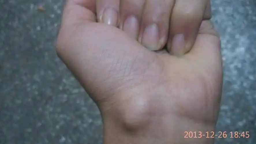 手腕这里凸出来的是不是骨质增生了