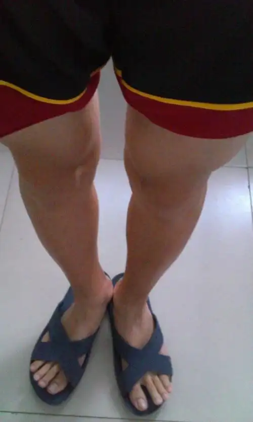 罗圈腿怎么治?我今年12有点轻微的罗圈腿,还有图片请看下面