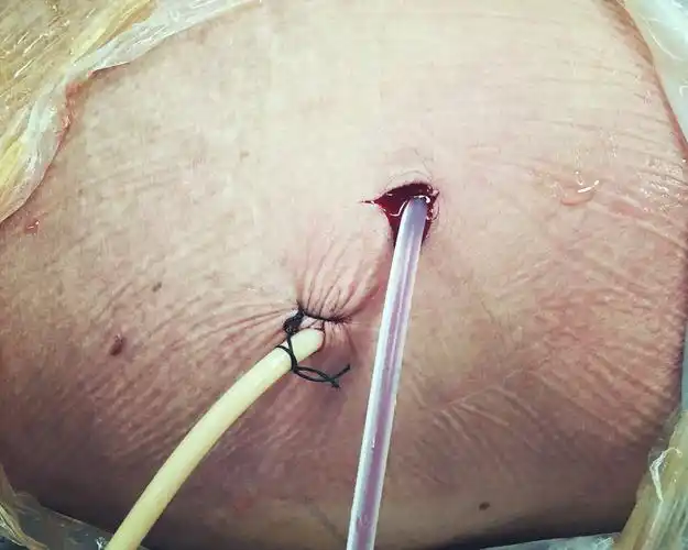 复杂鹿角型肾结石的综合治疗_肾结石_手术_治疗方式 - 好大夫在线