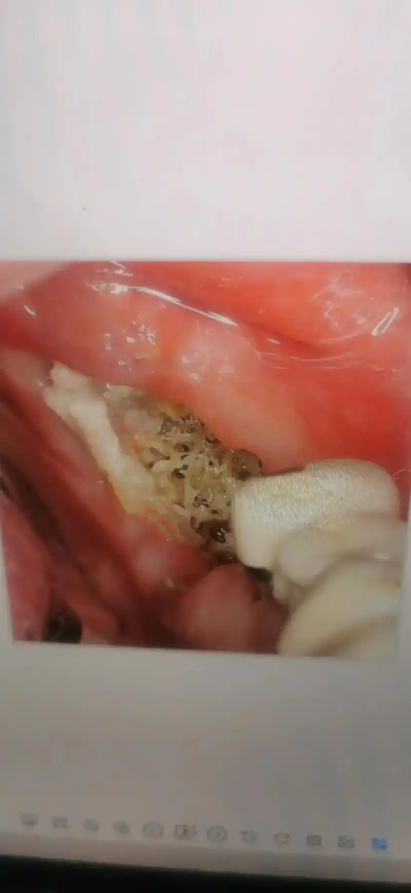 放射性颌骨骨髓炎,三低征:哈弗氏细胞活力降低,低02及动脉分 - 抖音