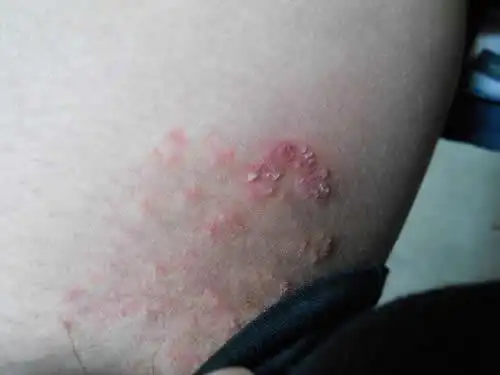 艾滋病初期皮疹图片:疱疹