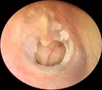 中耳炎鼓膜大穿孔,耳内镜微创手术快速治愈_鼓膜穿孔_鼓膜穿孔治疗