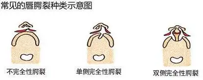 唇裂修复,还宝宝天使笑容-yestar武汉艺星整形美容医院