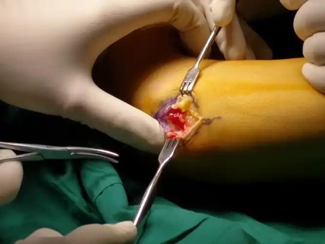 0416网球肘切开松解手术……鲁谊