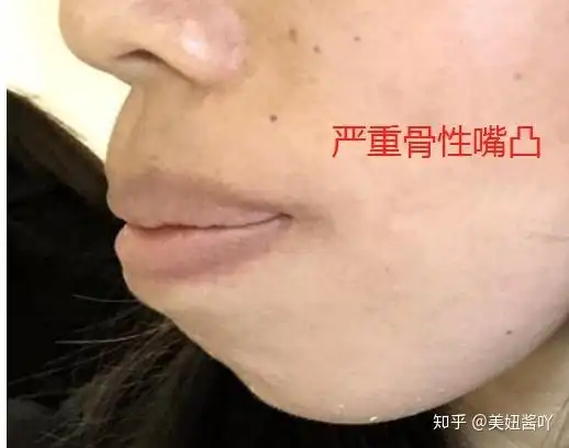 同样是凸嘴为什么你那么丑关于嘴凸改善的最全攻略