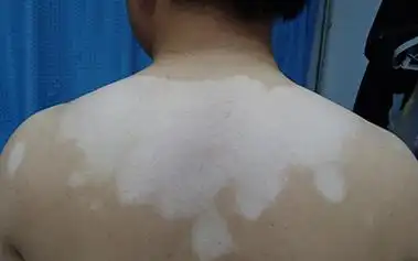 白癜风初期颜色较浅,白斑的形状不规则,常为1~2片分布,很多情况下是