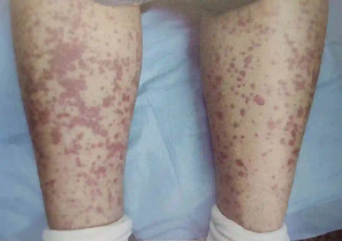 为什么成年过敏性紫癜患者也越来越多?  对于儿童过敏性紫癜患者主要