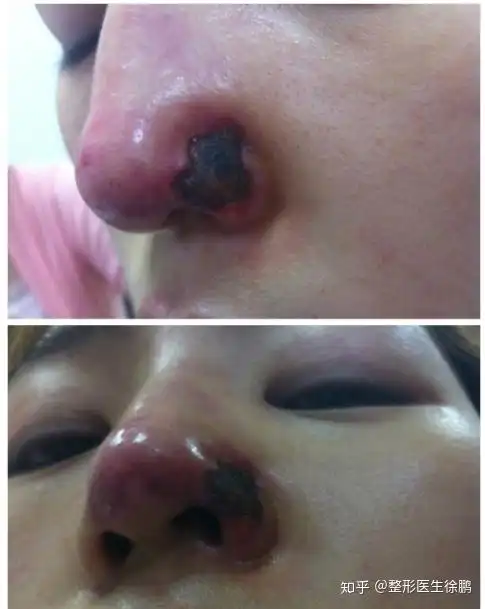 先来感受下玻尿酸隆鼻失败后的样子