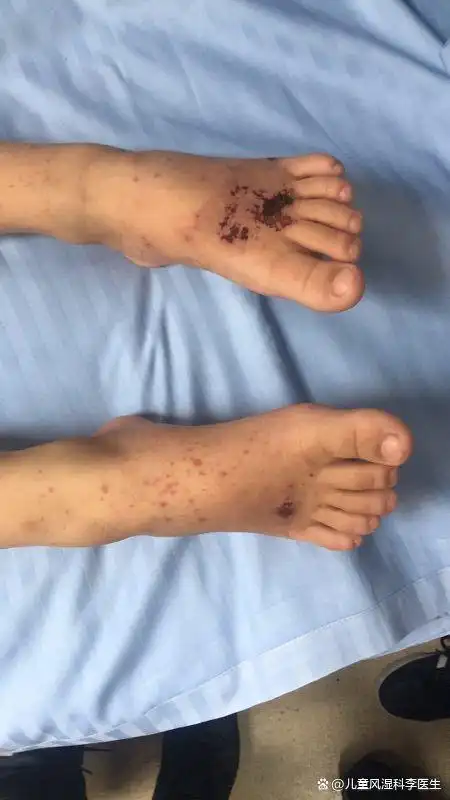 过敏性紫癜儿童的饮食选择