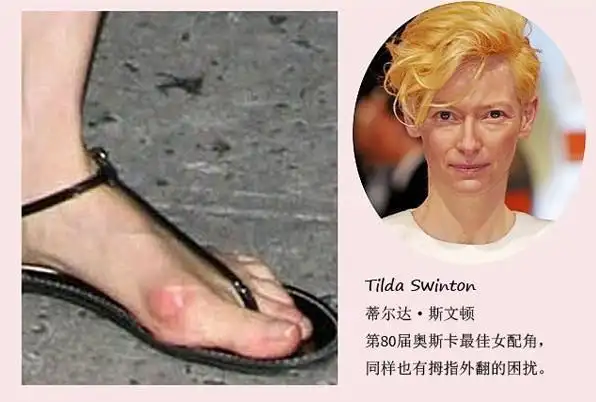 第80届奥斯卡最佳女配角,同样也有拇指外翻的困扰