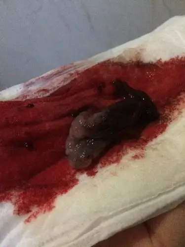 有图,介意者深慎入 药流后排出的孕囊从形状上能看出男女吗?排出可