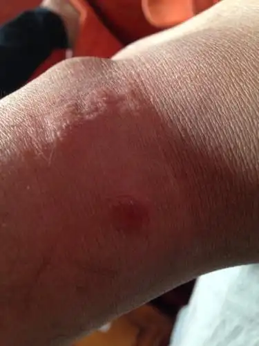 不知道怎么回事,这是被虫子咬的吗?好痒而且疙疙瘩瘩的,脚踝处